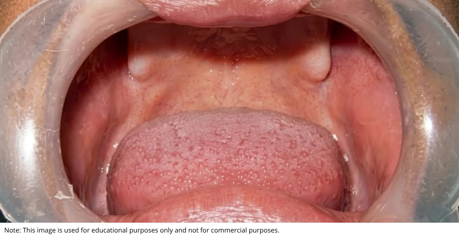 Anodontia Causes, Symptoms, and Treatment inlog